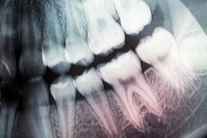 How to Know If Your Wisdom Teeth Are Coming in