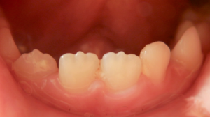 What Causes Jagged Teeth in Kids and Adults?