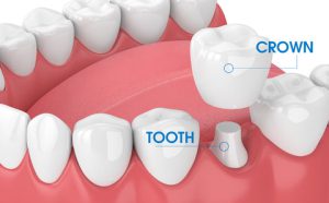 What Can You Eat and not eat with a Dental Crown?